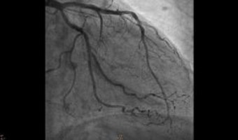 CORONOGRAFIA IN DAY HOSPITAL: I PROGRESSI MEDICI RIDUCONO I TEMPI DI DEGENZA