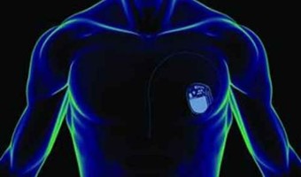 Il pacemaker diventa wireless: il ritmo cardiaco regolato con una mini batteria nel cuore