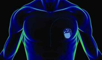 Il pacemaker diventa wireless: il ritmo cardiaco regolato con una mini batteria nel cuore