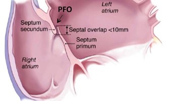 Chiusura rivoluzionaria del forame ovale pervio (PFO), mediante una sutura con noblestich