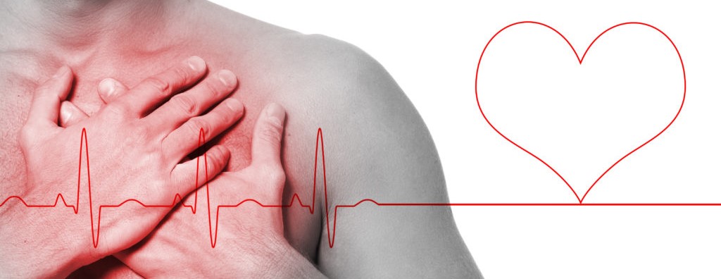 infarto miocardico