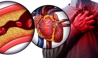 Angina, Infarto, Angioplastica: Il tempo è muscolo.