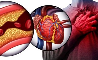 Angina, Infarto, Angioplastica: Il tempo è muscolo.